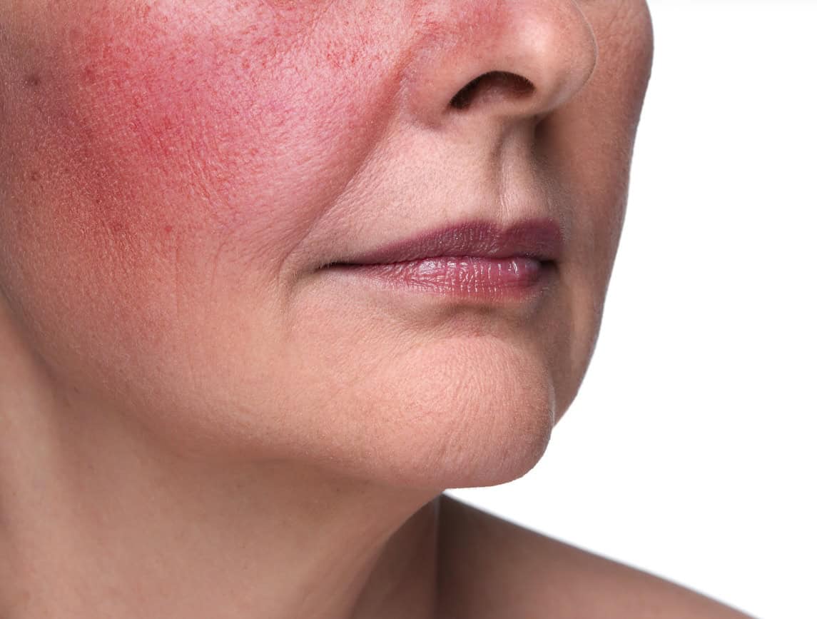 Rosacea: Understanding Facial Redness, Flushing, and Inflammatory Flares